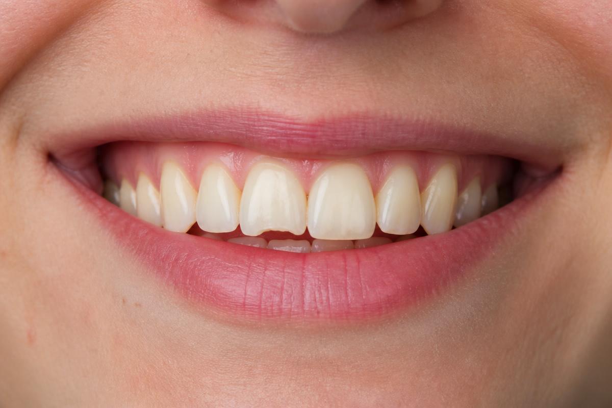 Dental Veneers before