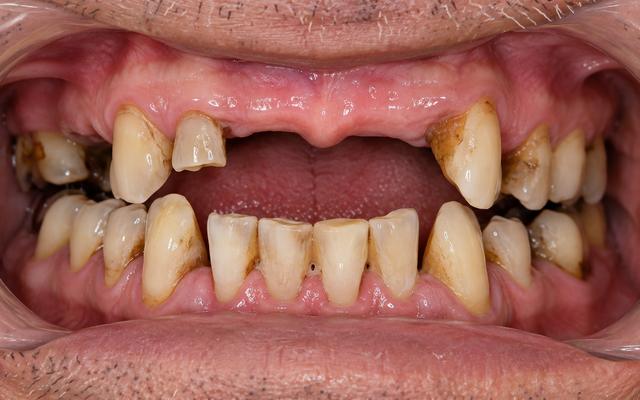 Before: multiple missing teeth