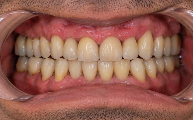 After: after full mouth restoration