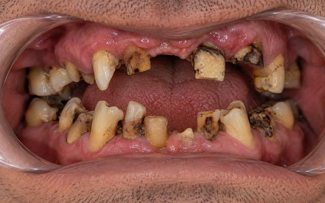 Before: a worn, gapped smile